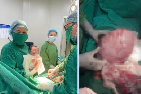 Xử lý thành công khối u xơ tử cung nặng 1,6kg và đón bé trai chào đời