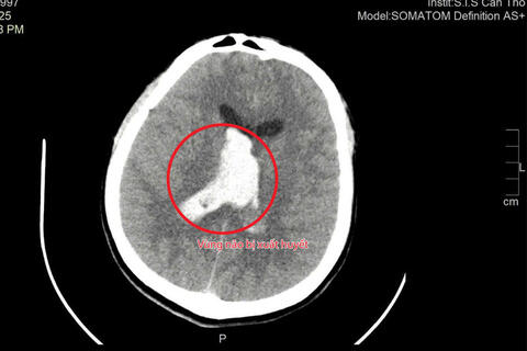Thầy giáo trẻ bị đột quỵ được cứu sống trong gang tấc
