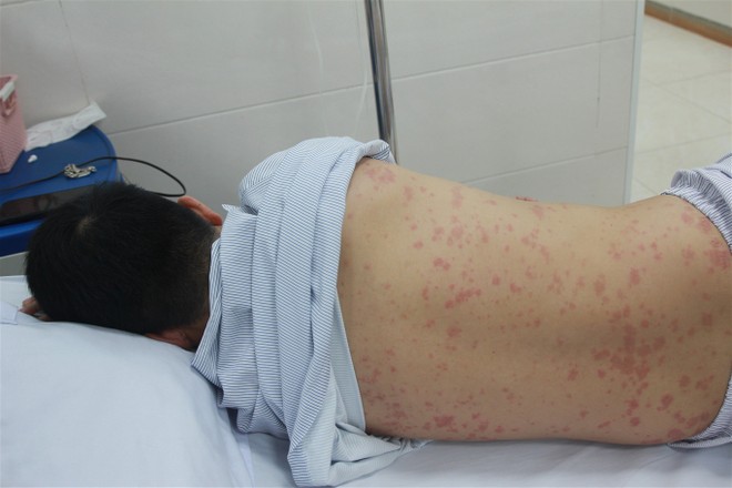 Số bệnh nhân nhiễm liên cầu khuẩn lợn thường gia tăng trong mùa nóng