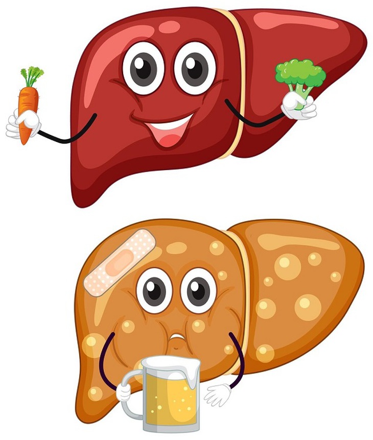 Không uống rượu bia vẫn bị gan nhiễm mỡ, ăn gì để ‘gan khỏe’? - Ảnh 1. gan nhiễm mỡ - Ảnh 1.