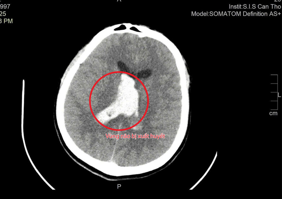 Hình ảnh vùng não bị xuất huyết. Ảnh: BVCC. thay-giao-dot-quy-2.jpg